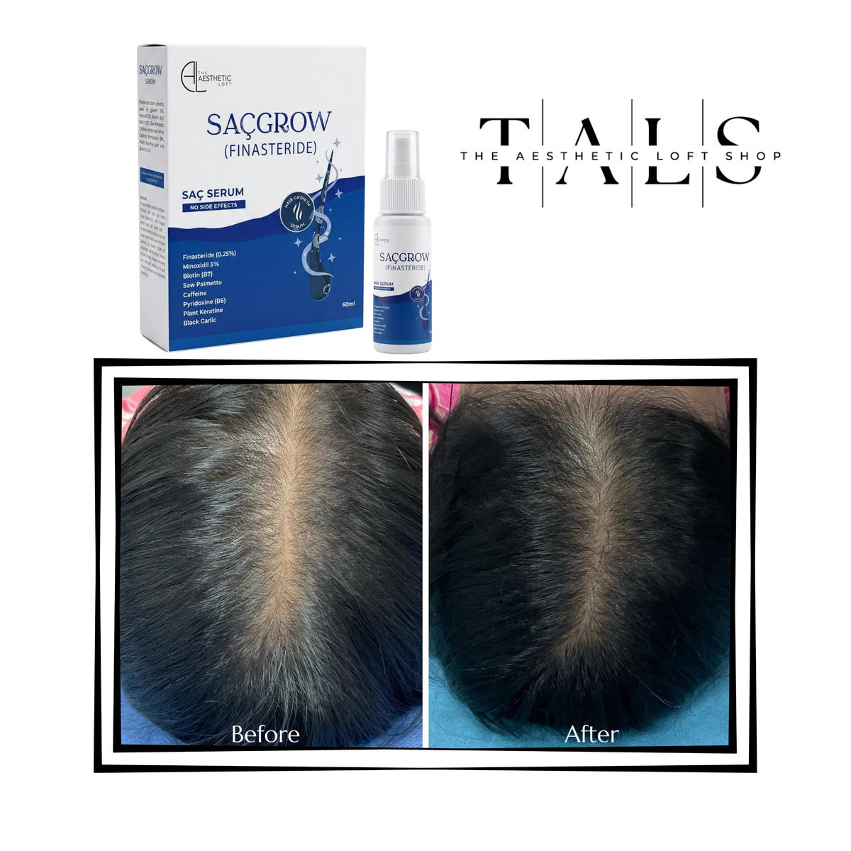 Saçgrow (Finasteride) Serum